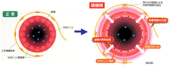 片頭痛について