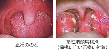 喉 の 痛み 抗生 物質