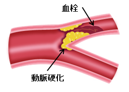 院長コラム：血液さらさらを考える(2)