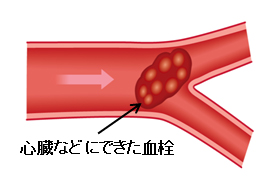 血液さらさらを考える