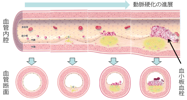 血液さらさらを考える