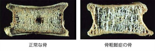 院長コラム：骨粗鬆症について(1)