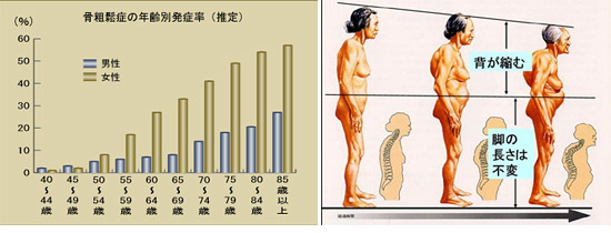 院長コラム：骨粗鬆症について(1)