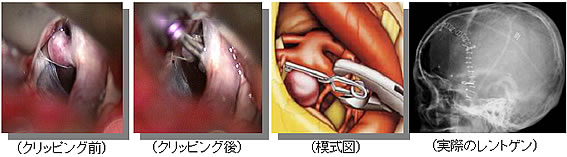 クモ膜下出血について