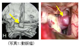 院長コラム：クモ膜下出血について