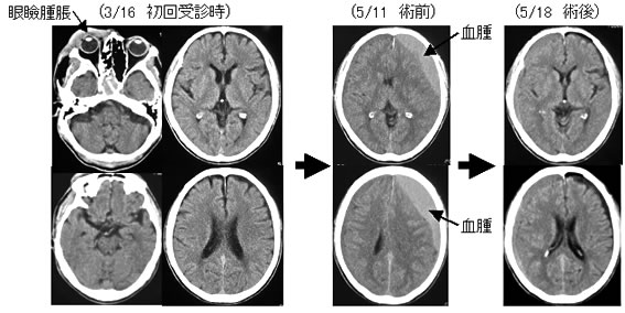 慢性硬膜下血腫について