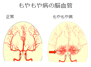 院長コラム：もやもや病(1)