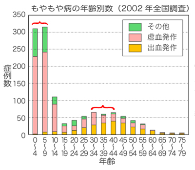 院長コラム：もやもや病(2)