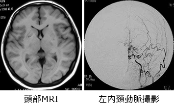 院長コラム：もやもや病(2)