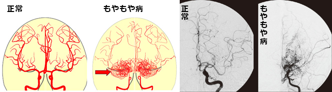 院長コラム：もやもや病(3)