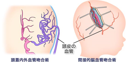 院長コラム：もやもや病(3)