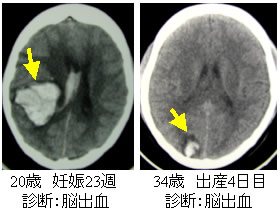 妊婦の脳卒中について