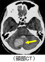 院長コラム：脳出血について(1)