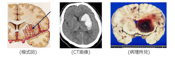 院長コラム：脳出血について(2)