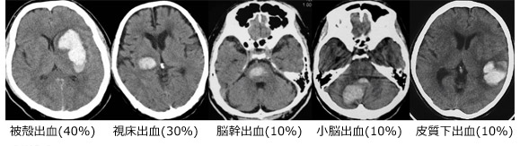 院長コラム：脳出血について(3)