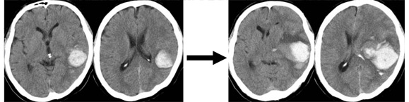 院長コラム：脳出血について(3)