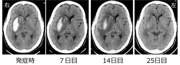 院長コラム：脳出血について(4)