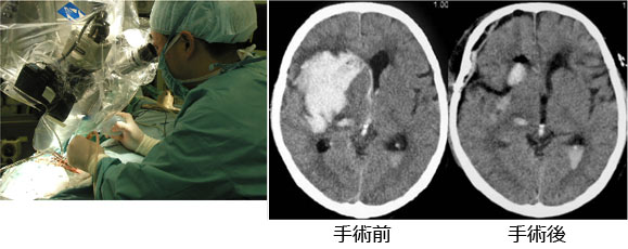 脳出血について