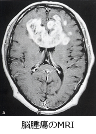 院長コラム：脳腫瘍(1)