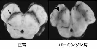 パーキンソン病について