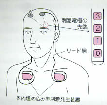 パーキンソン病について