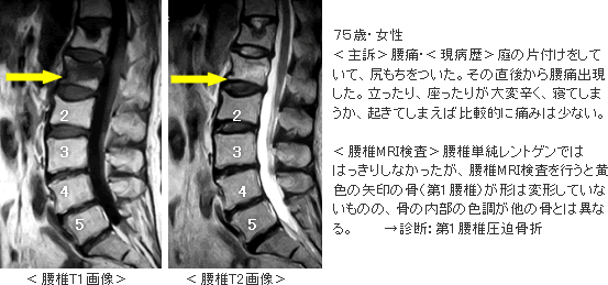 院長コラム：脊椎圧迫骨折の例