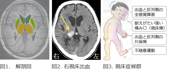 と 視床 は 出血