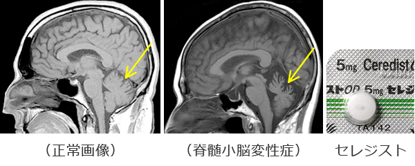 院長コラム：神経難病(5)