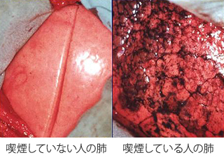 院長コラム：タバコをやめよう(3)