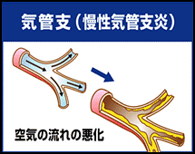 タバコをやめよう