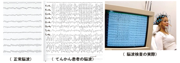 てんかんについて