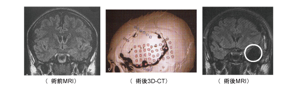 頭 てんかん 側 葉