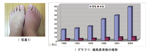 高尿酸血症(痛風)について