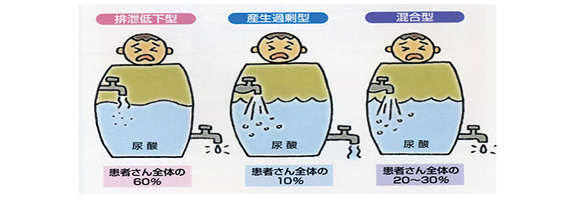 院長コラム：高尿酸血症(痛風)について(2)