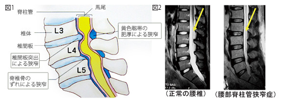 腰痛について