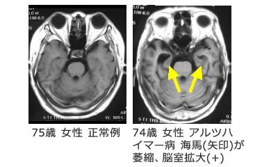 認知症について