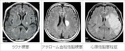 脳梗塞について