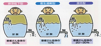 高尿酸血症(痛風)について